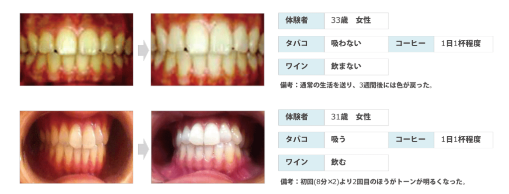 歯のホワイトニング
