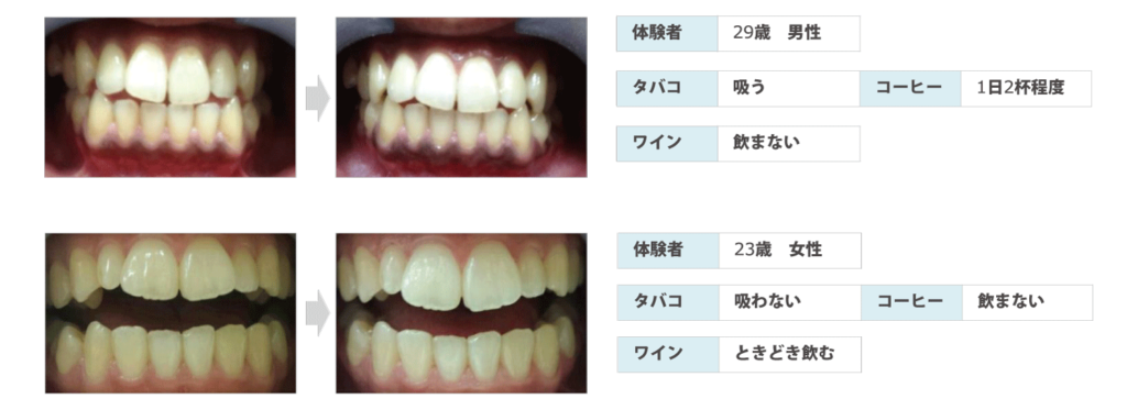 歯のホワイトニング